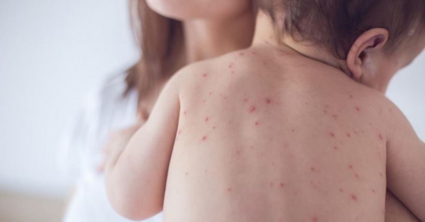 Vắc xin MMR II 3 trong 1 phòng các bệnh thường gặp ở trẻ